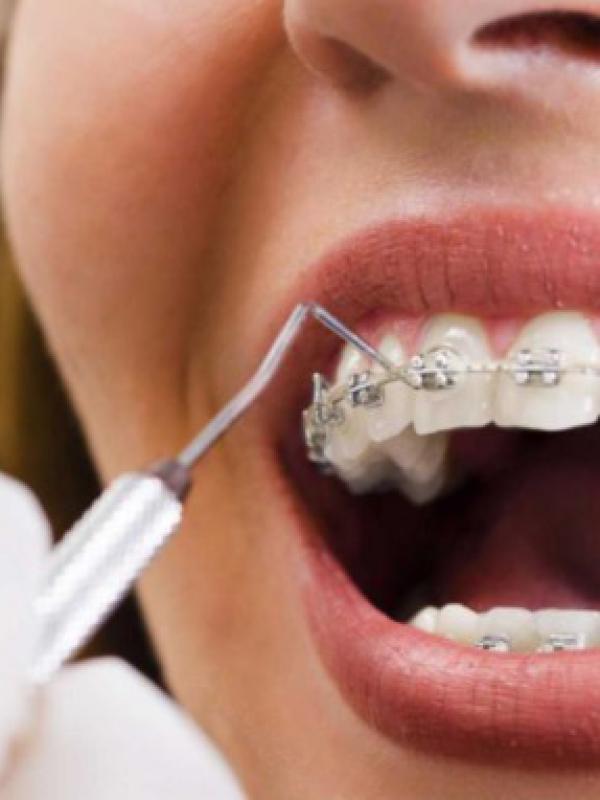 Dental prosthetics